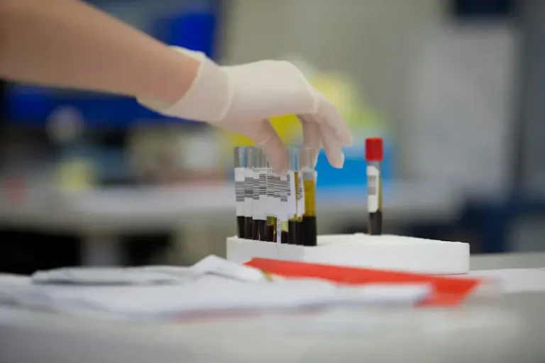 Mano con guantes sosteniendo tubos de ensayo con muestras de suero para un análisis de ácido úrico